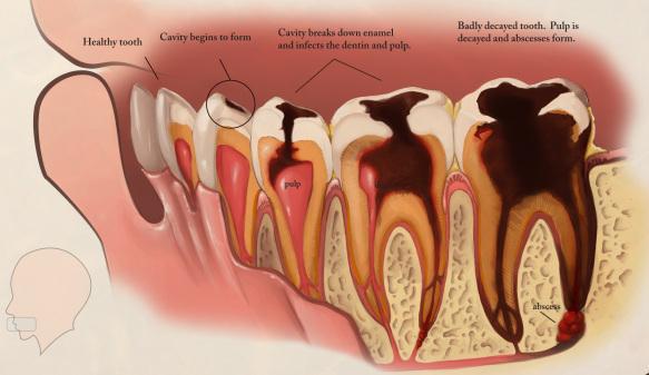 does a how does a tooth decay sabka dentist dental clinic in india does a how does a tooth decay sabka dentist dental clinic in india