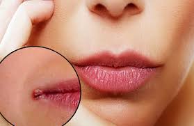 Painful cracks at the corners of the mouth?