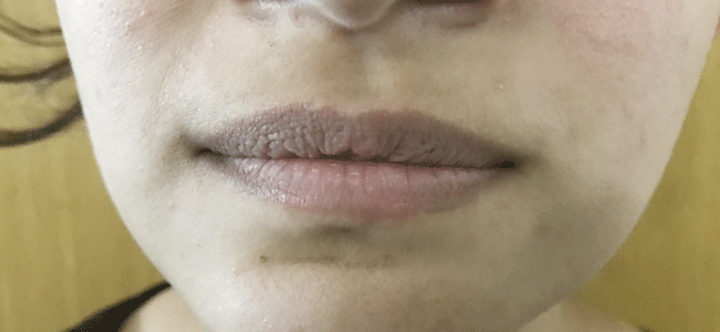 3 Facial Exercises for the Perfect Smile - Sabka Dentist Dental Clinic