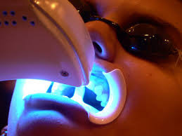 laser teeth bleaching