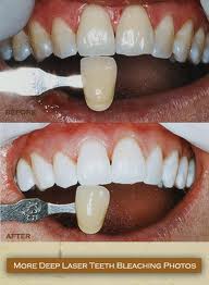 laser teeth bleaching before and after