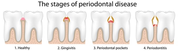 periodontitis