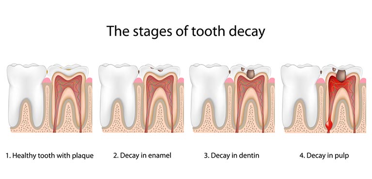 tooth decay