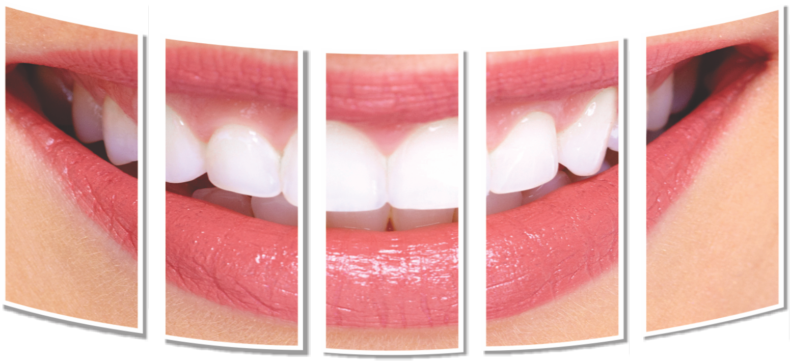 Easy EMI options at 0 Interest for Dental Treatments in India