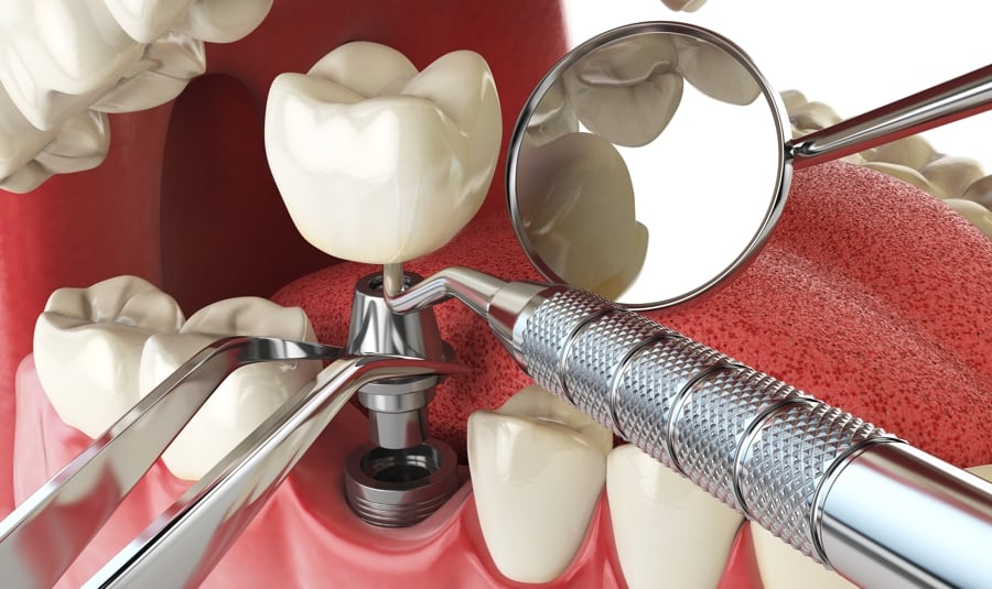 Dental Implants