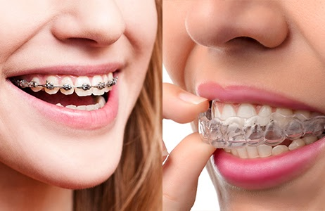 orthodontic braces