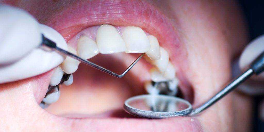 cavities