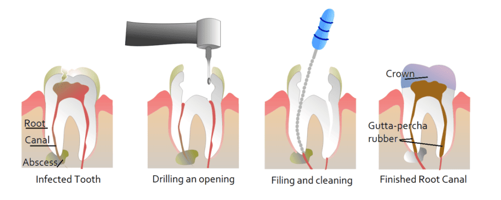 Root Canal Treatment Root Canal Treatment, Best Root Canal Treatment Cost In India | Best Tooth Root Canal Treatment