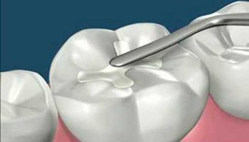 Composite Fillings