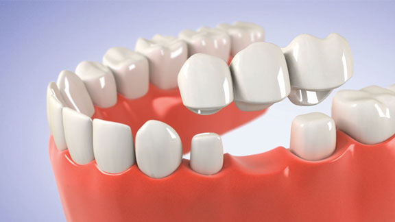 dental bridges