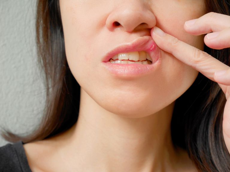 mouth ulcer