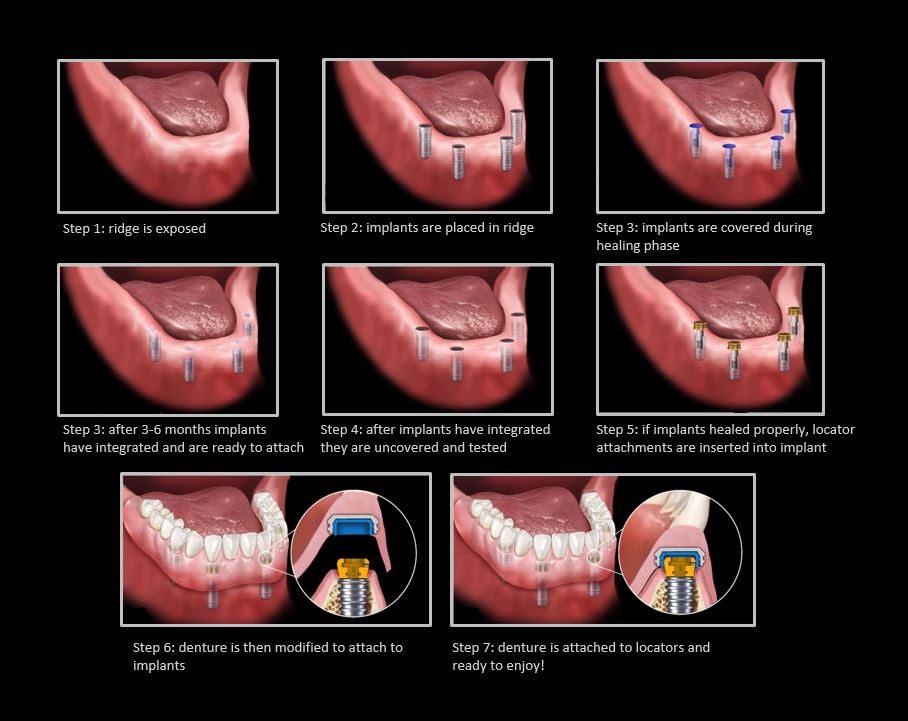 overdenture procedure
