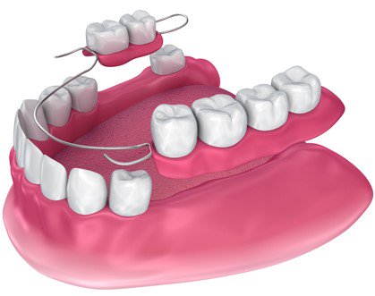 partial denture