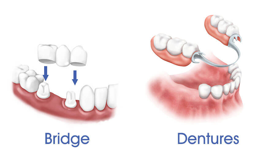 partial denture