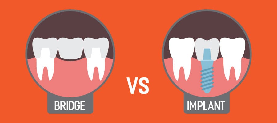 Implants Vs bridges