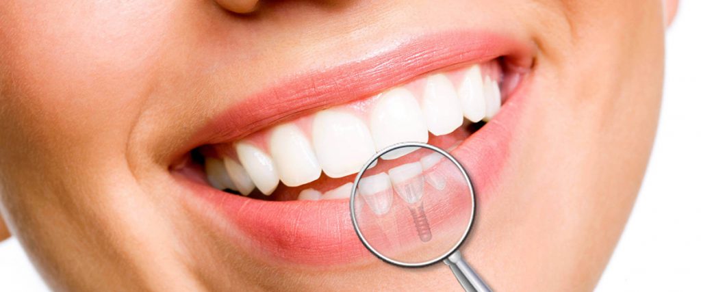 dental implant