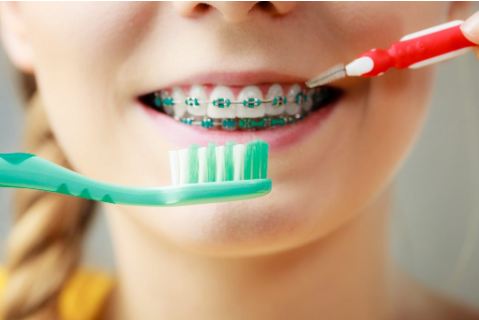 How to keep your braces clean?