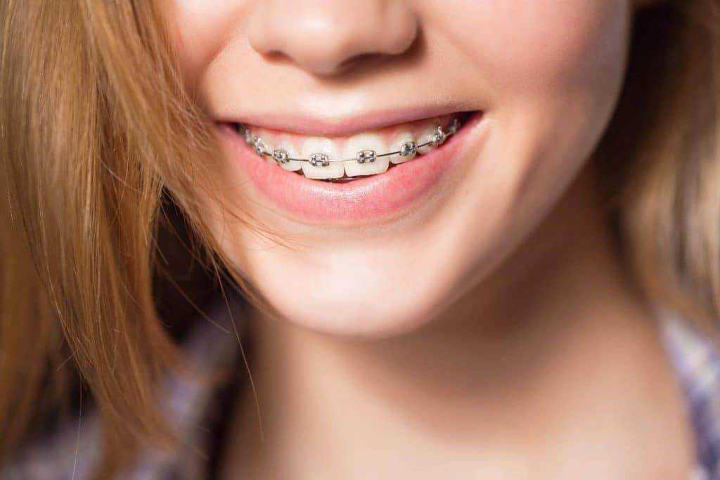 know about your braces